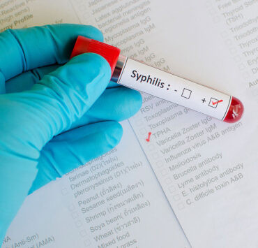 Hand in einem blauen Handschuhe hält einen positiven Syphilis-Test