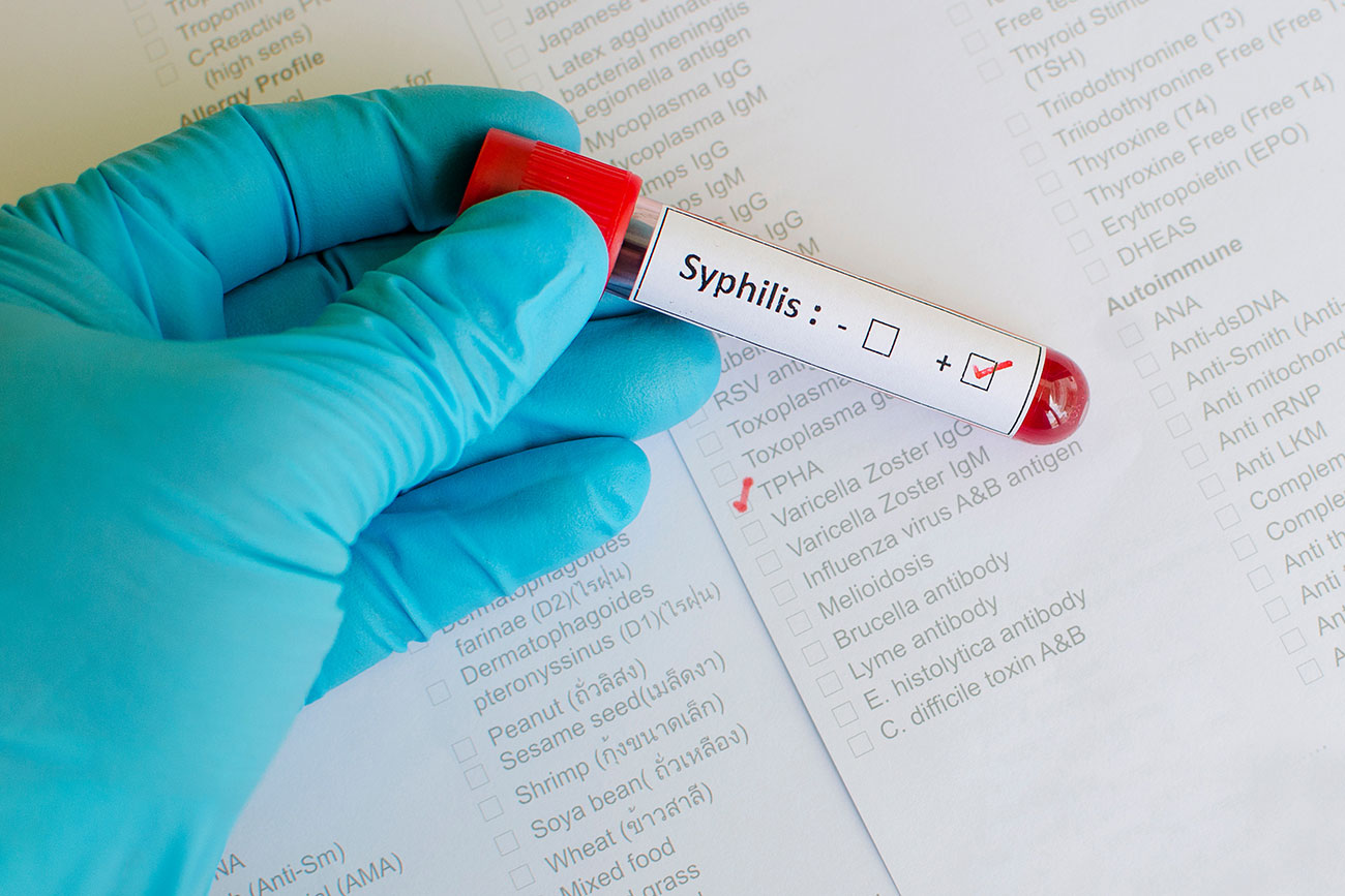 Hand in einem blauen Handschuhe hält einen positiven Syphilis-Test